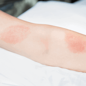 arm with rashes