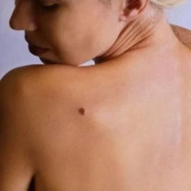 person looking over shoulder at skin blemish