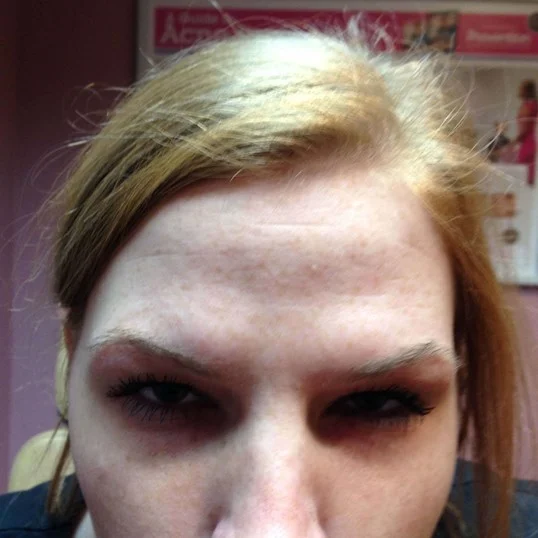 botox after photo