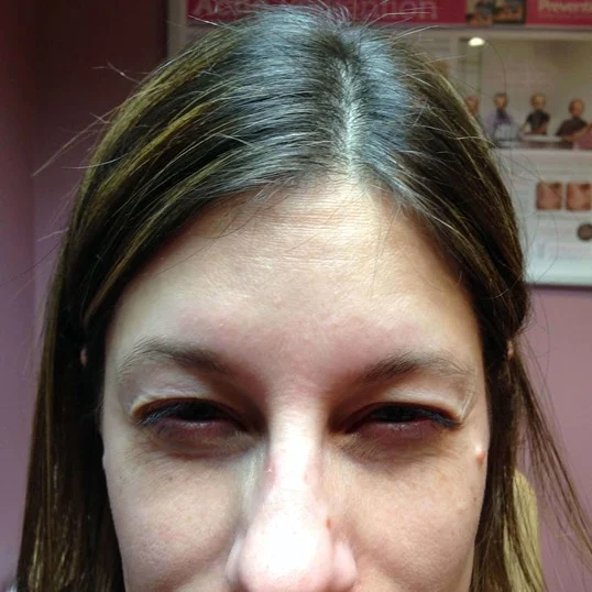 botox after photo