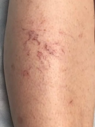 sclerotherapy before photo