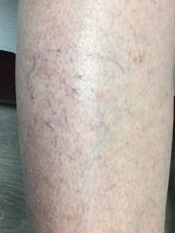 sclerotherapy after photo