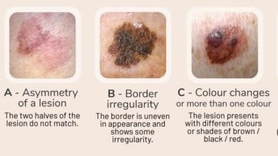 comparison of skin abnormalities