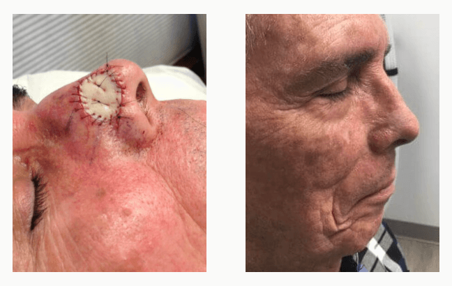 skin cancer surgery before and after