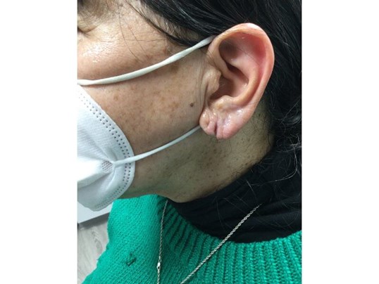 earlobe repair surgery before photo