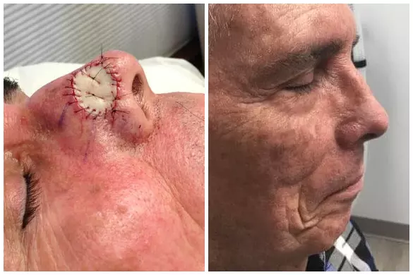 skin cancer surgery before and after photo
