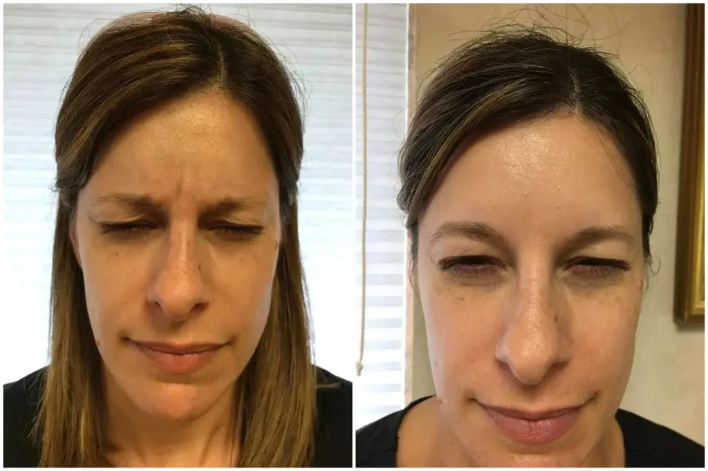 botox before and after photo