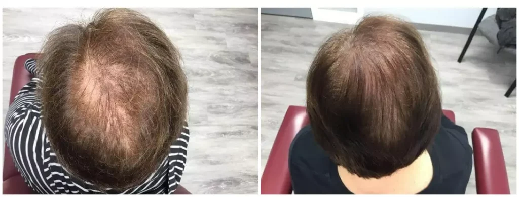 hair therapy before and after photo