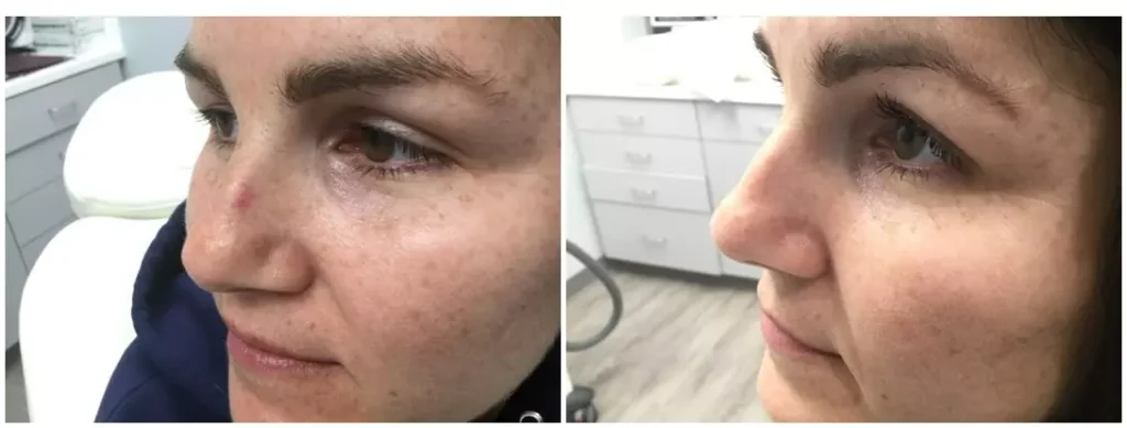 laser vein removal before and after photo