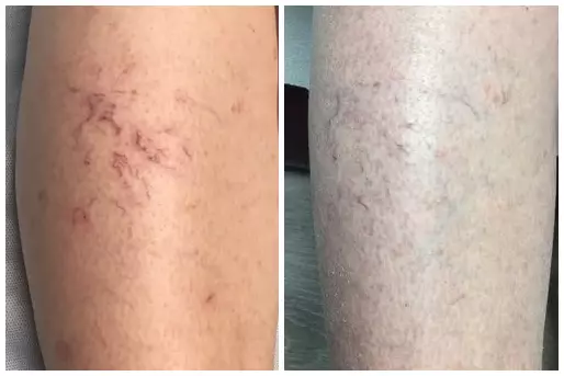 sclerotherapy before and after photo