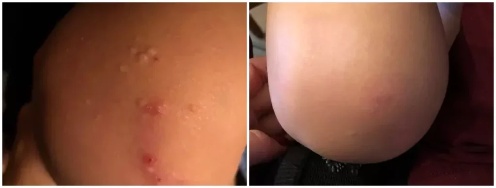 topical therapy before and after photo