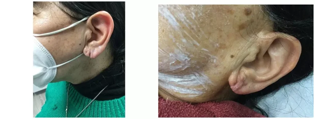 earlobe repair surgery before and after photo