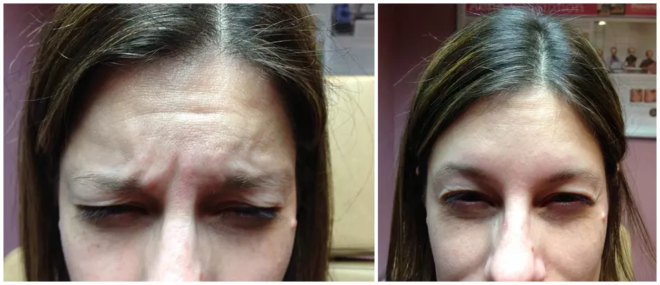 botox before and after photo