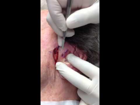 mohs skin surgery being performed